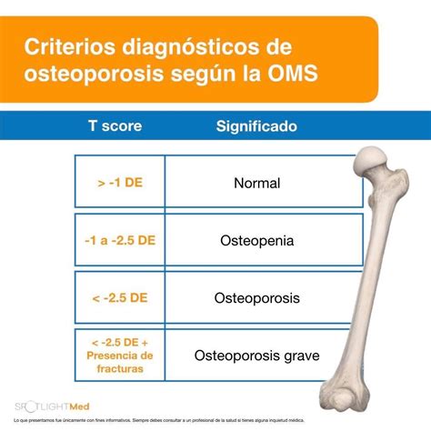 Tabla: Criterios diagnósticos de osteoporosis según OMS (T-Score)