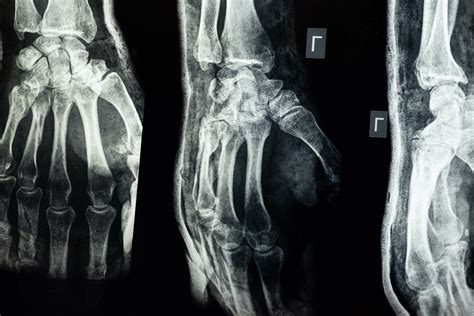 Ilustración: Localizaciones comunes de fracturas por fragilidad (columna, cadera, muñeca)