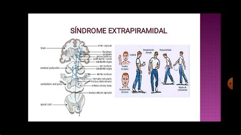 Ilustración de una persona experimentando efectos extrapiramidales (temblor, rigidez)