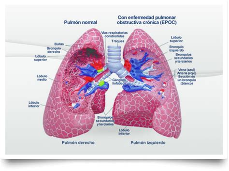Esquema de los pulmones y la localización del cáncer
