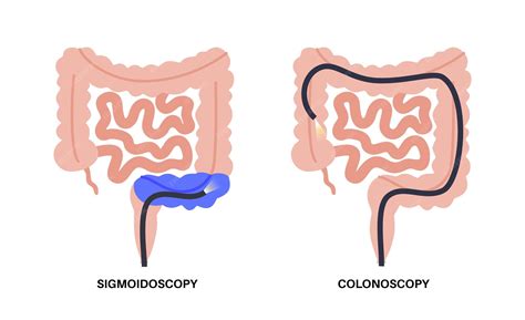 Infografía comparando colonoscopia y sigmoidoscopia, destacando sus diferencias en alcance y preparación.