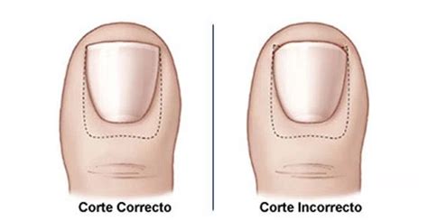 Esquema: Técnica correcta de corte de uñas en línea recta