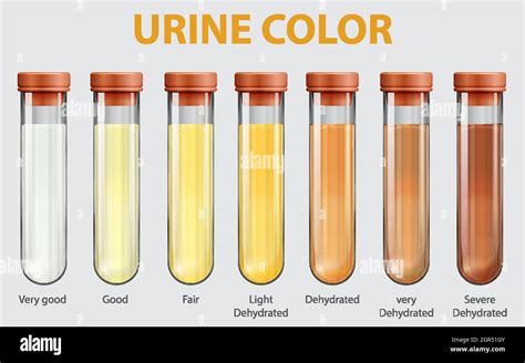 Espectro de colores de orina normal y anormal