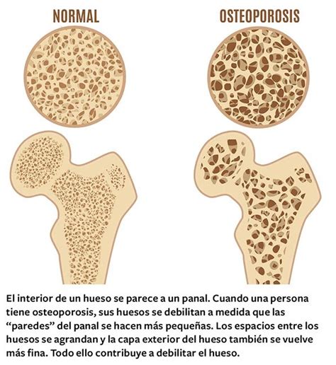Esquema de huesos con osteoporosis en comparación con huesos sanos