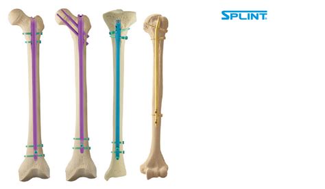 Ilustración de clavos intramedulares para fracturas