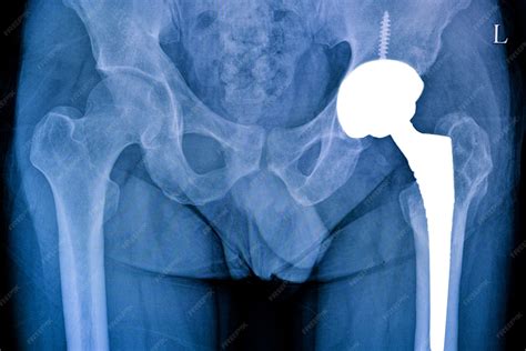 Radiografía de cadera con prótesis total