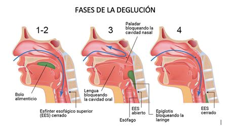 Esquema de las fases de la deglución humana y las áreas afectadas por la disfagia orofaríngea