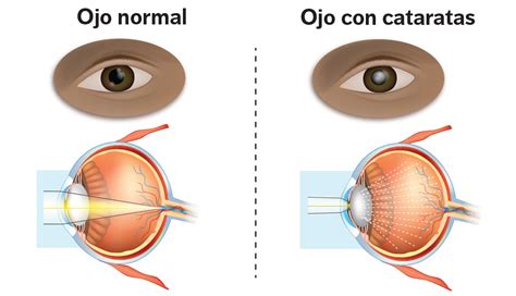 Diagrama de un ojo con cataratas