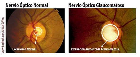 Ilustración del nervio óptico afectado por glaucoma