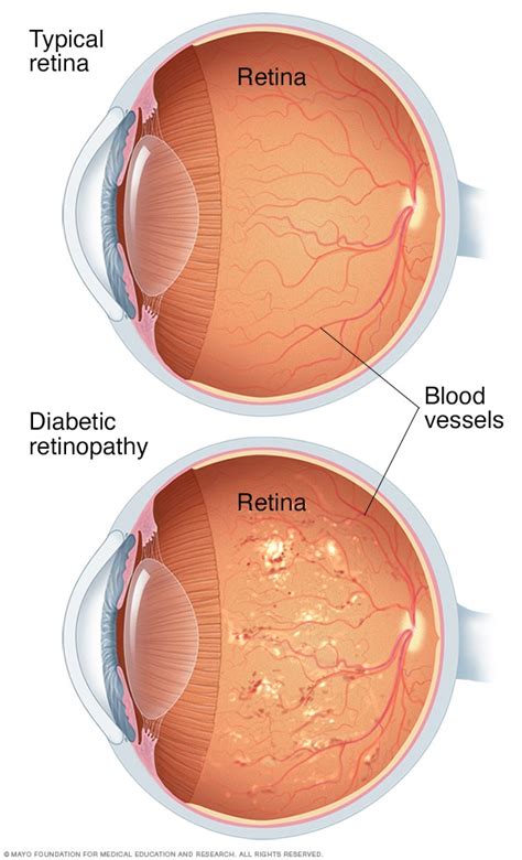 Esquema de la retina afectada por retinopatía diabética