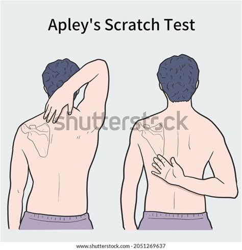 Ilustración del Back Scratch Test
