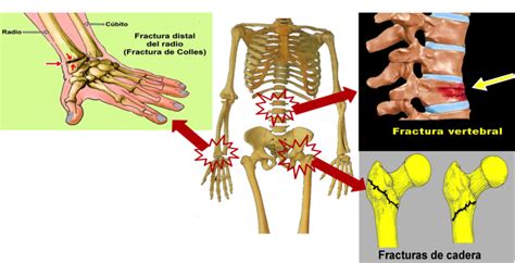 Esquema: Localizaciones más frecuentes de fracturas por fragilidad: cadera, columna vertebral, muñeca y húmero proximal.