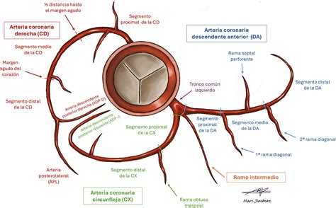 Diagrama de las arterias coronarias mostrando un bloqueo y su efecto en el flujo sanguíneo al corazón.