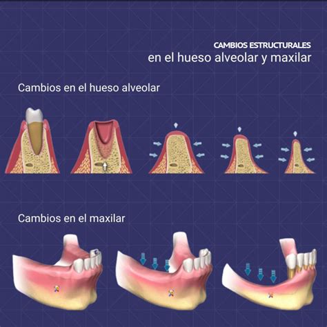 Esquema anatómico que muestra los cambios en el hueso alveolar, atrofia de mucosas y pérdida de piezas dentales por envejecimiento
