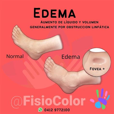 Ilustración mostrando la diferencia entre edema con y sin fóvea.