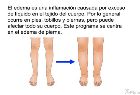 Infografía con consejos prácticos para el manejo del edema en casa: elevación de piernas, ejercicio, dieta baja en sal.