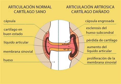 Esquema de articulación sana y articulación con artrosis