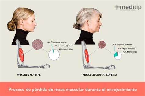 Infografía mostrando la disminución de la masa muscular con la edad y los síntomas de la sarcopenia