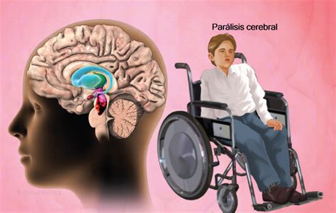 Tabla comparativa de causas comunes: Parálisis cerebral, espina bífida, distrofias musculares y lesiones medulares