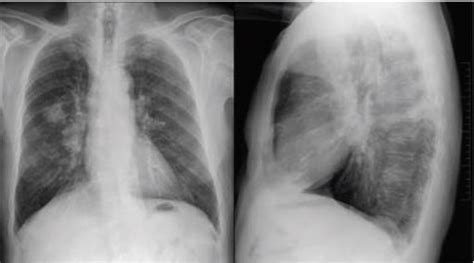 Radiografía de tórax mostrando adenopatías mediastínicas