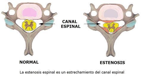 Diagrama que ilustra la estenosis espinal y la compresión del nervio ciático.