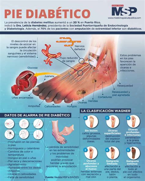 Infografía: señales de alerta y cuidados preventivos esenciales para los pies de pacientes diabéticos