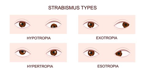Diferentes tipos de estrabismo: esotropía, exotropía, hipertropía, hipotropía