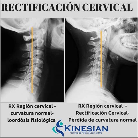 Esquema anatómico comparativo: columna cervical con lordosis fisiológica frente a columna con rectificación cervical y sus implicaciones biomecánicas.