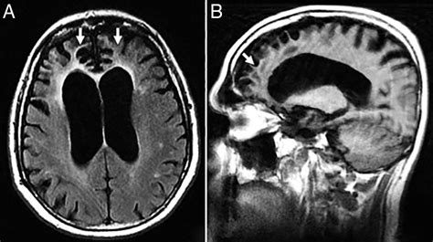 Resonancia magnética de cerebro mostrando atrofia cerebral en demencia