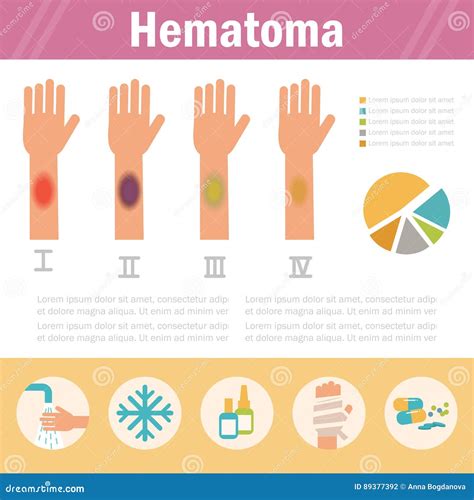Esquema de la formación de un hematoma y su evolución de color
