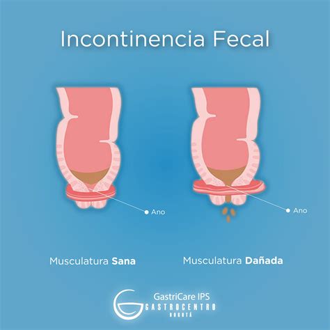 Diagrama de las diferentes opciones quirúrgicas para la incontinencia fecal
