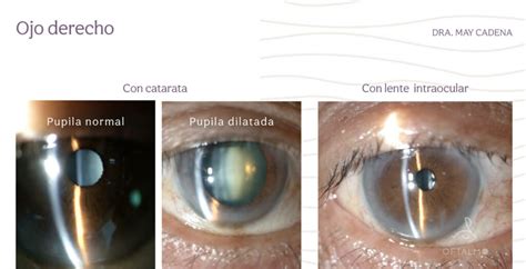 Detalle de un ojo con catarata y la ilustración de un corazón latiendo fuertemente