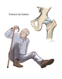 Esquema de las causas y factores de riesgo de fracturas de cadera en personas mayores