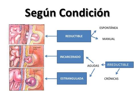 Infografía: Diferencia entre hernia reducible, encarcelada y estrangulada