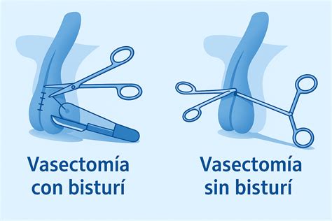 Diferencias entre vasectomía con bisturí y sin bisturí