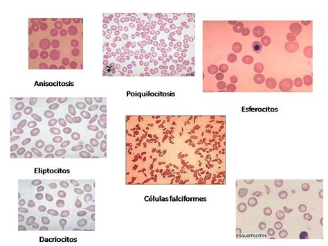 Micrografía de eritrocitos con diferentes morfologías (anisocitosis y poiquilocitosis).