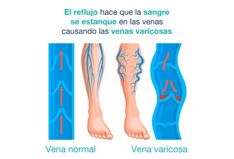 Fotografía de piernas con varices y signos de edema, mostrando el enrojecimiento y la hinchazón