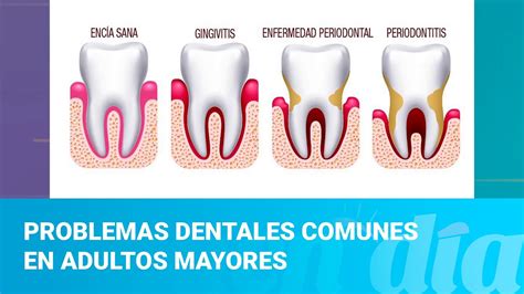 infografía sobre causas de problemas dentales en adultos mayores