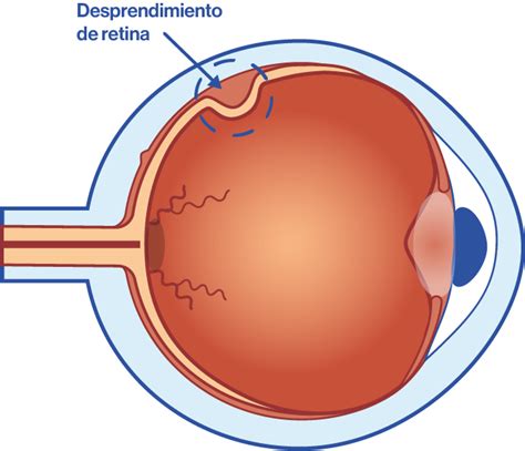 Ilustración que muestra un desprendimiento de retina