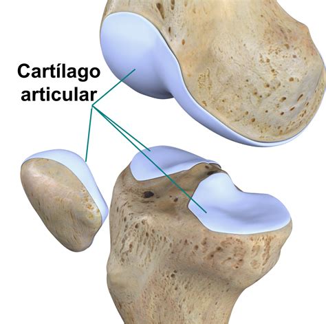 Esquema o infografía sobre el desgaste del cartílago en la osteoartritis