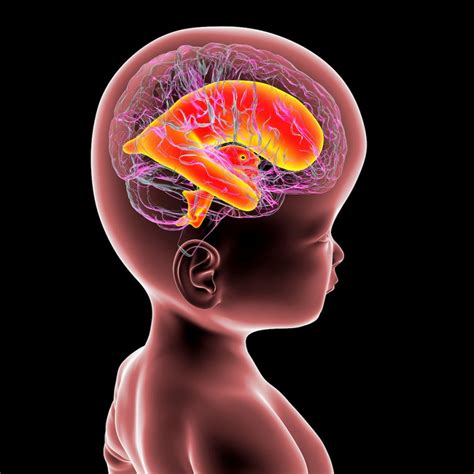 Ilustración del desarrollo cerebral afectado por la falta de estimulación auditiva