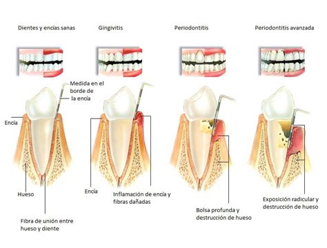 Diagrama: Progresión de la enfermedad periodontal y sus efectos