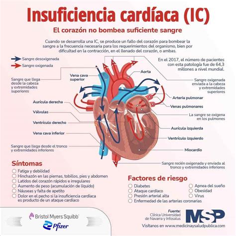 Infografía sobre la insuficiencia cardíaca y sus síntomas