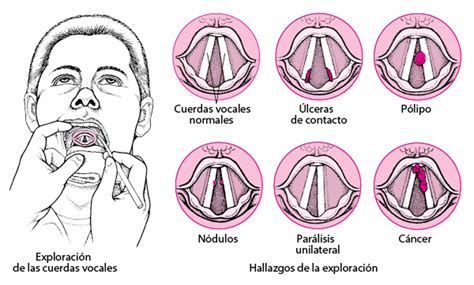 Imagen de nódulos en las cuerdas vocales
