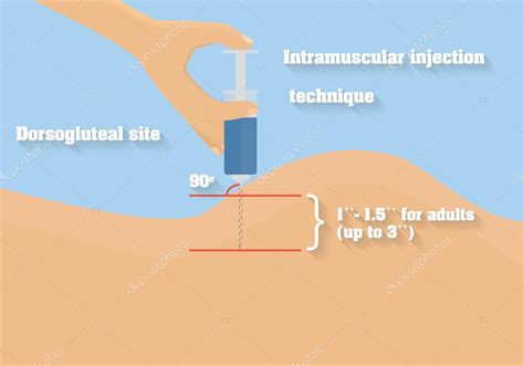 Ilustración de las zonas anatómicas para inyección intramuscular