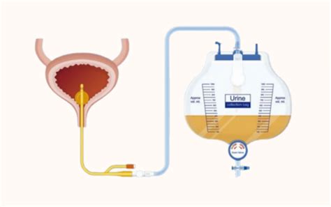 Esquema anatómico mostrando la colocación de una sonda vesical en la vejiga
