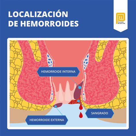 Ilustración de las posibles complicaciones del estreñimiento, como hemorroides o fisuras.