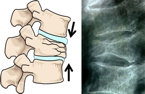 Esquema de una vértebra fracturada en la columna vertebral