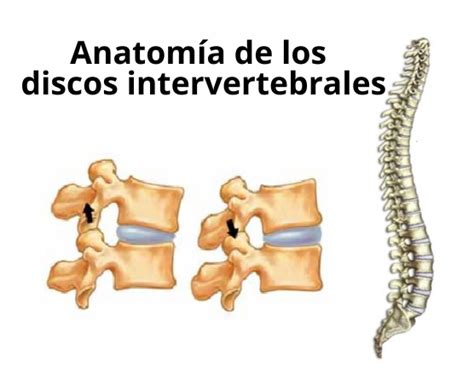 Infografía mostrando la degeneración de discos intervertebrales y articulaciones facetarias en una columna vertebral.