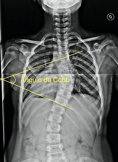 Radiografía de columna vertebral mostrando una escoliosis con la medición del ángulo de Cobb.